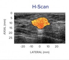 Patented ultrasound technologies improve diagnosis for cancer and other diseases