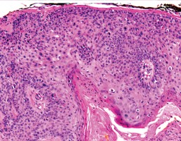 ASCO 2025: Avelumab cetuximab combo improves PFS for for cutaneous squamous cell carcinoma