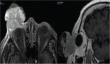 1946-bulky-palpebral-merkel-cell-carcinoma-of-the-eyelid