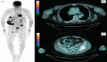 1947-immunotherapy-and-local-therapies-in-metastatic-laryngeal-cancer-management-a-case-report