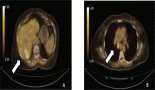 1949-atezolizumab-induced-neuromuscular-syndrome-mimicking-myasthenia-gravis-in-a-patient-with-hepatocellular-carcinoma-an-area-of-concern