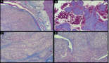 Enigmatic presentation of glomus tumour of the tongue: diagnostic insights