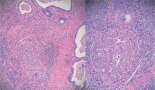 Primary urothelial carcinoma of the prostate: report of two cases and review of the literature