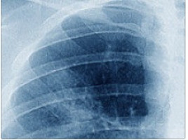 Diabetes drug makes lung cancer vulnerable to radiotherapy