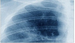 Experimental drugs developed for breast cancer could treat lung cancer too
