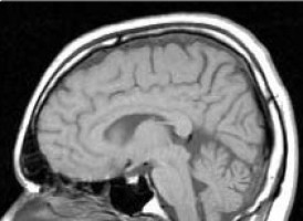 Discovery of likely subtypes of rare childhood brain tumour signals diagnostic advance