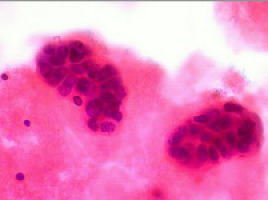 ECC 2013: The State of Oncology 2013 - a new report draws attention on disparities in cancer care