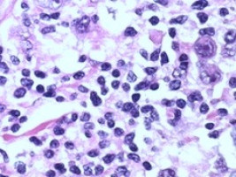 A potent weapon against lymphomas