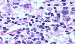A potent weapon against lymphomas