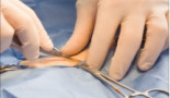 Xanit aplica una técnica pionera para destruir un tumor en una vértebra