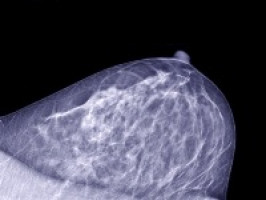 Nuevos resultados del estudio de cáncer de mama publicados en The Lancet