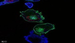 OMS: más de 14 millones de nuevos casos de cáncer y 8 millones de fallecimientos