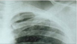 Aplican en México una técnica para erradicar el cáncer óseo con calor