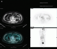 A new choice for young women with pre-cancerous cervical disease